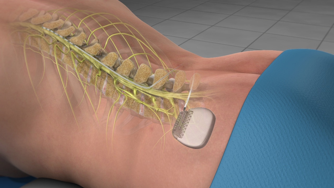 Spinal Cord Stimulation (SCS) in Davenport, IA